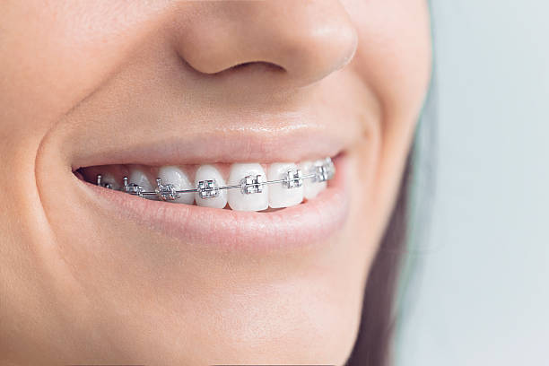 Best Veneers and Lumineers  in Lake Don Pedro, CA